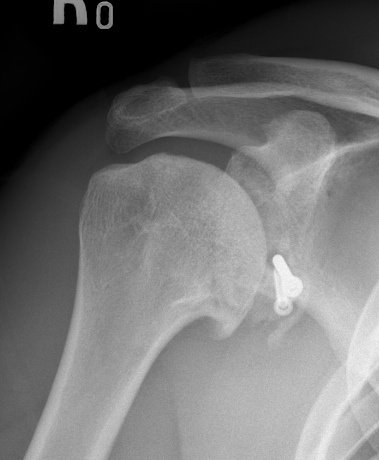resorption