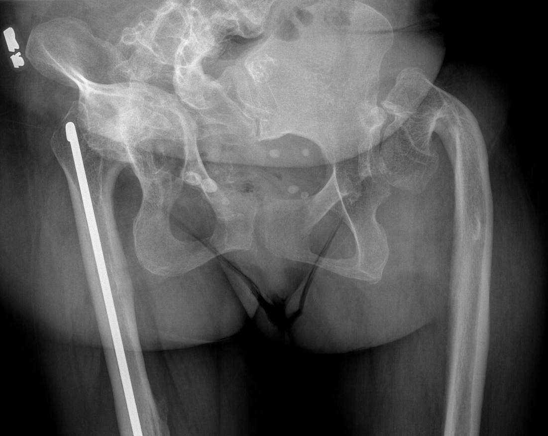 OI hips