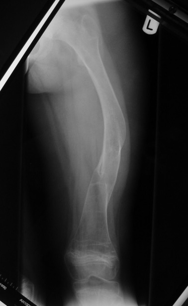 OI femur