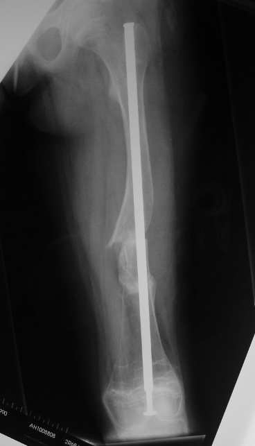 OI femur
