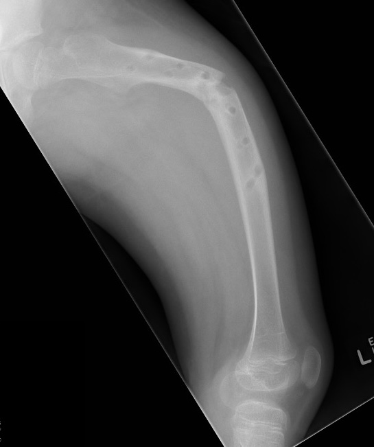 OI femur