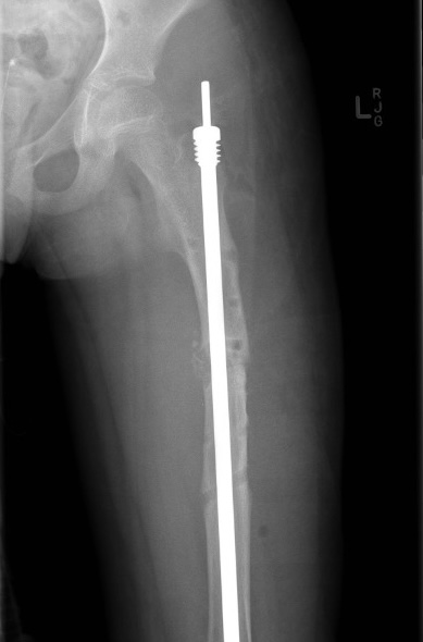 OI femur