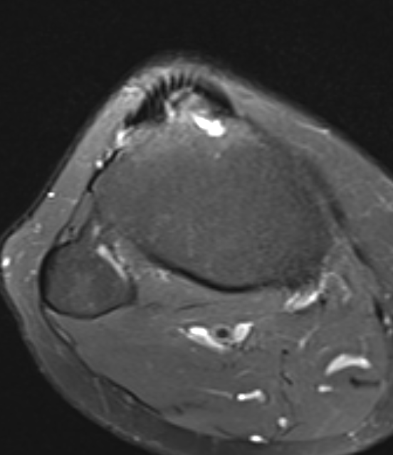 MRI