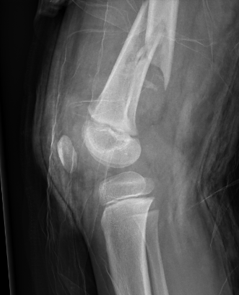 Dis femur