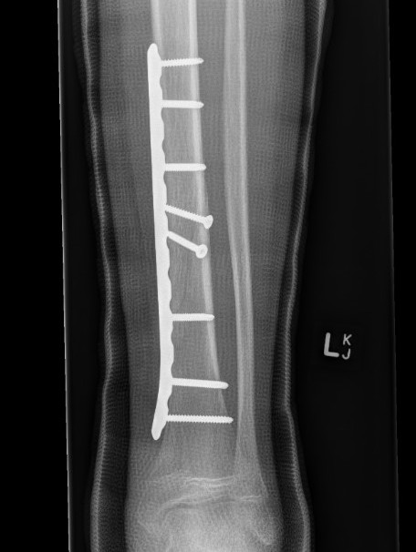 tib plate