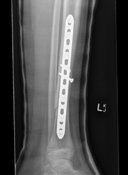 tib shaft