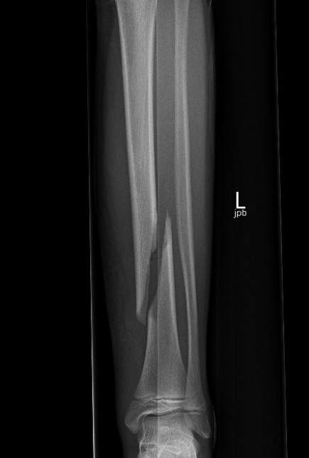 tib plate