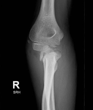 Radial neck