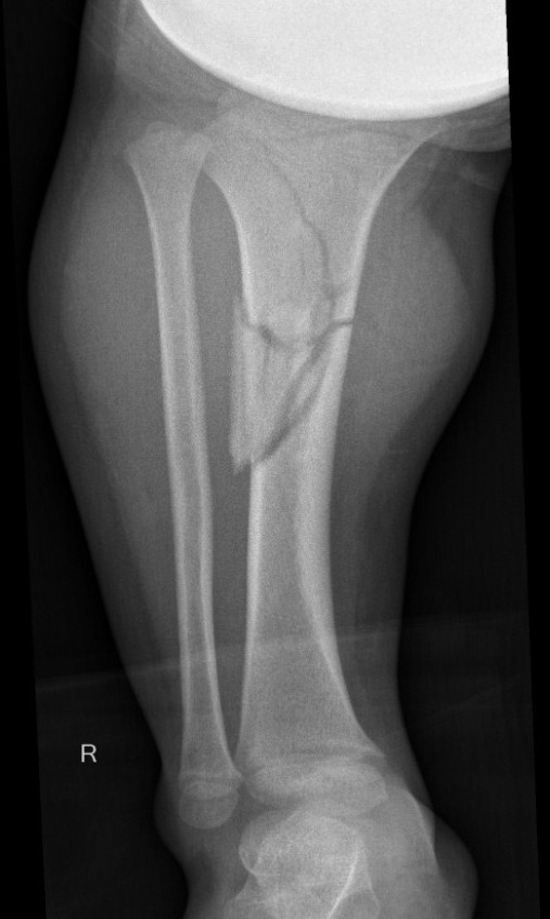 tibia