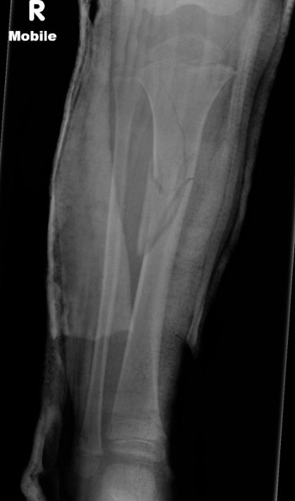 tibia