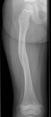 femur