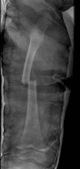 femur
