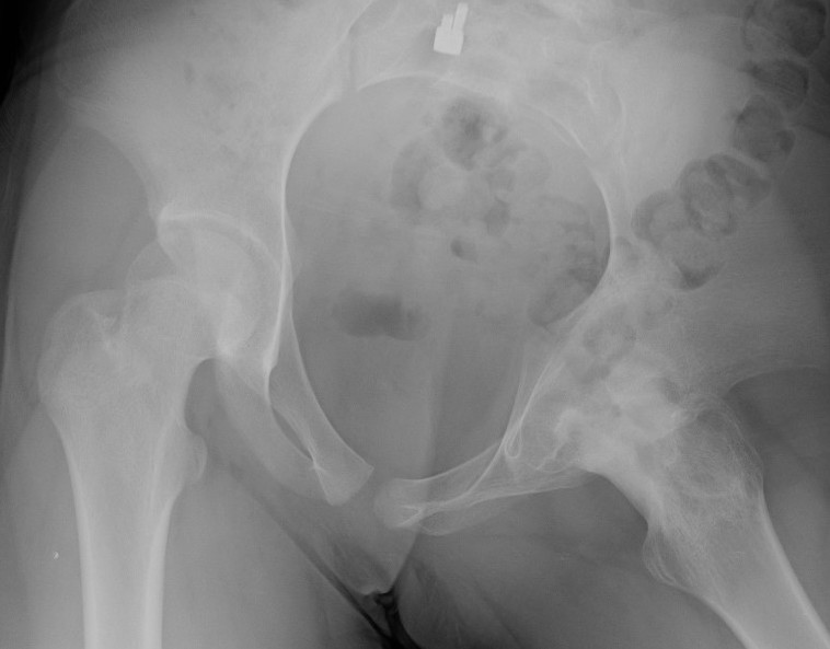 Septic arthritis
