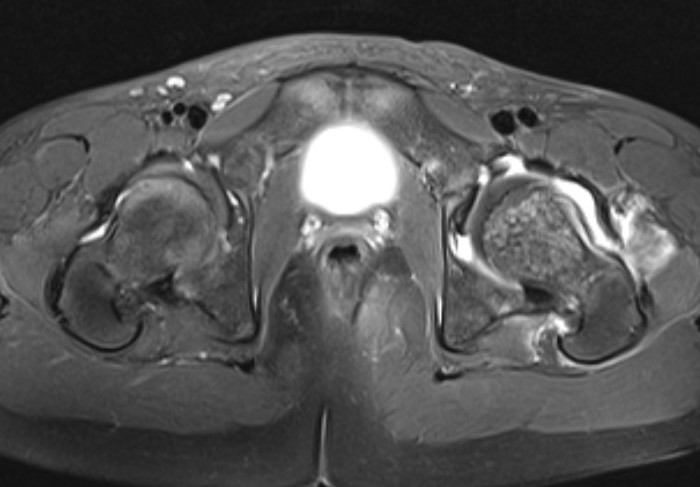 Septic arthritis