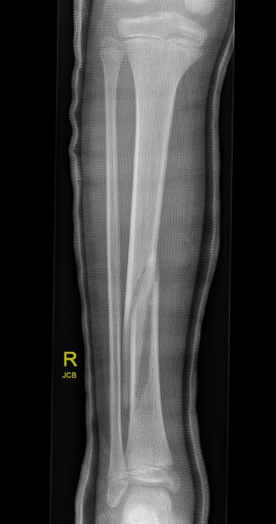 tibia
