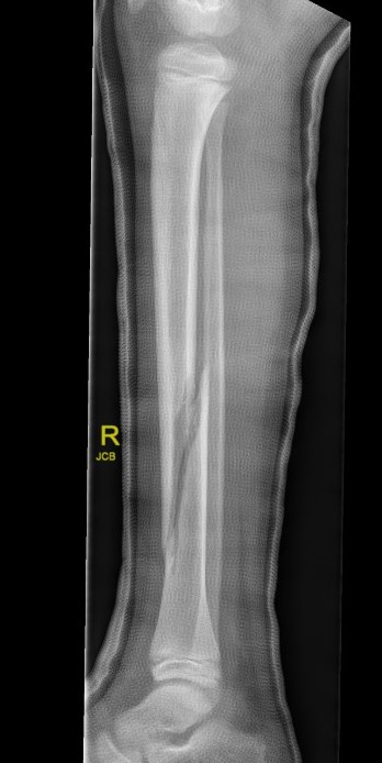tibia