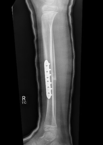 tib plate