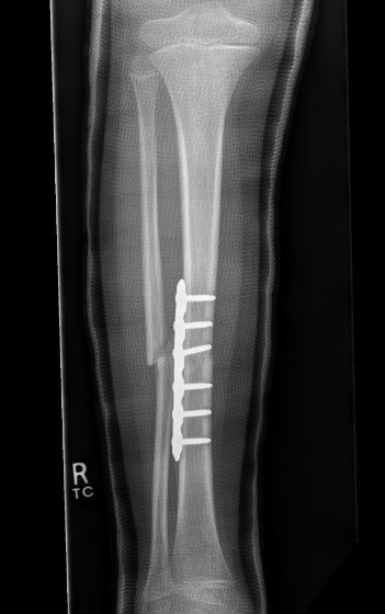 tib plate