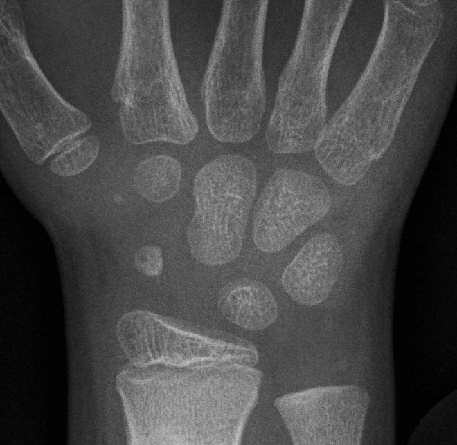 Ped carpal bones
