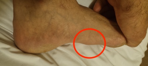 Fibroma