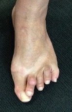 Hammer toe