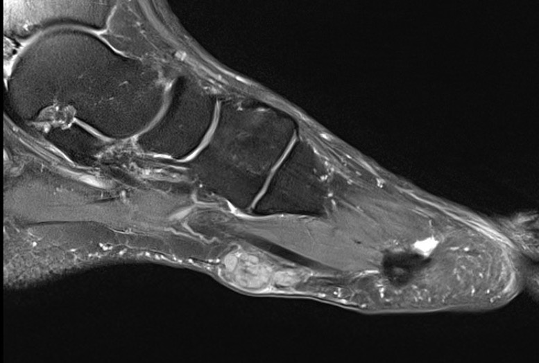 fibroma