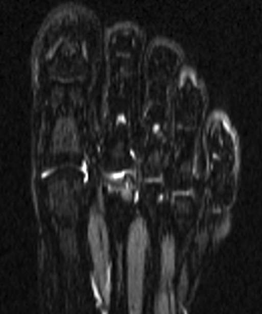 Focal chondral defect