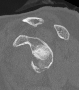 glenoid