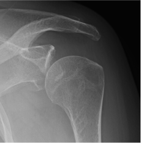 glenoid