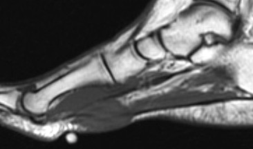 fibroma