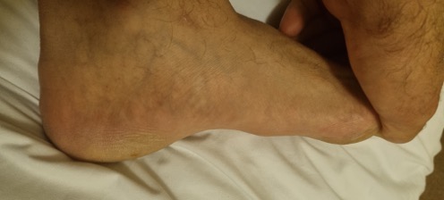 Fibroma