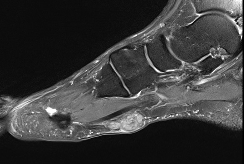 fibroma