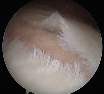 Posterior OA