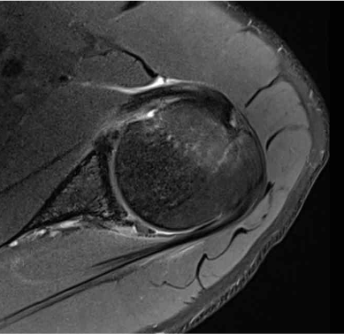 posterior labral tear