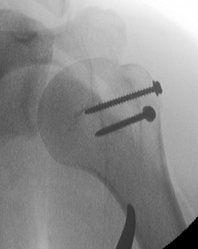 GT fixation