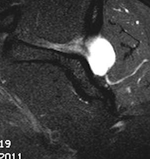 labral cyst