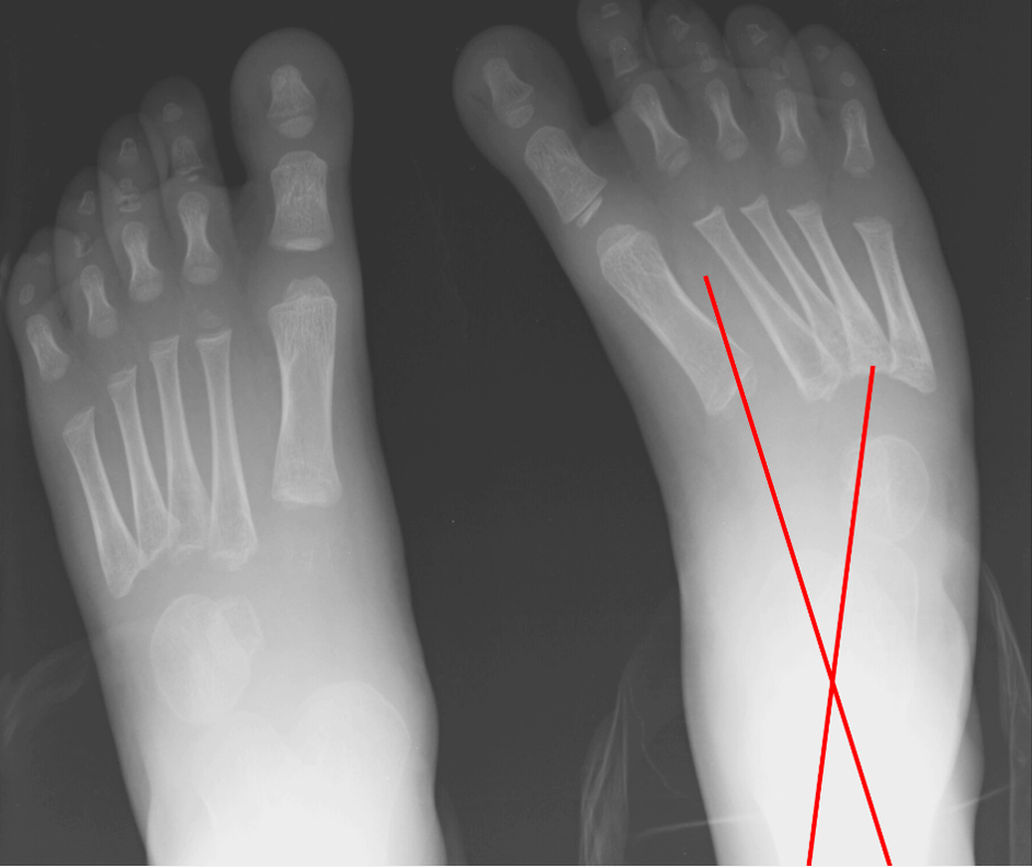 Xray
