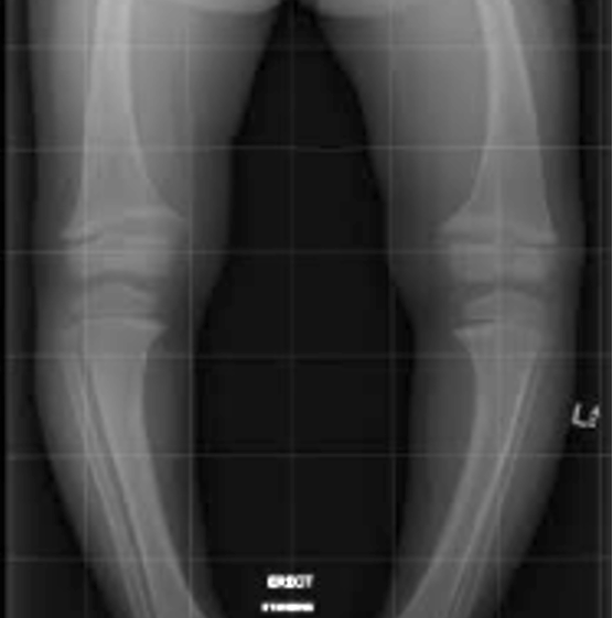 Rickets
