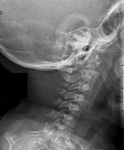 Achondroplasia
