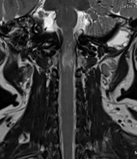 Foramen magnum stenosis