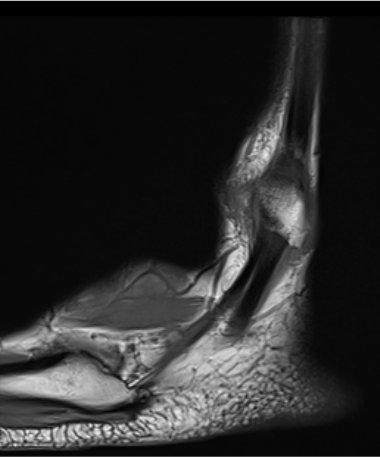 Peroneal dislocation