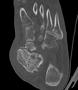Charcot