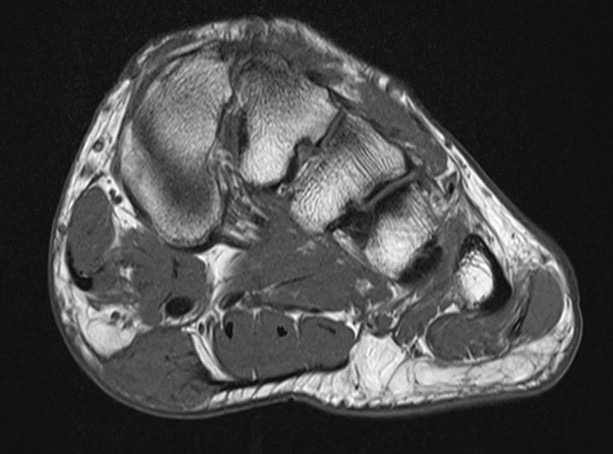 fibroma