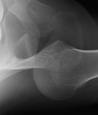ax lateral