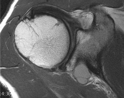 labral cyst