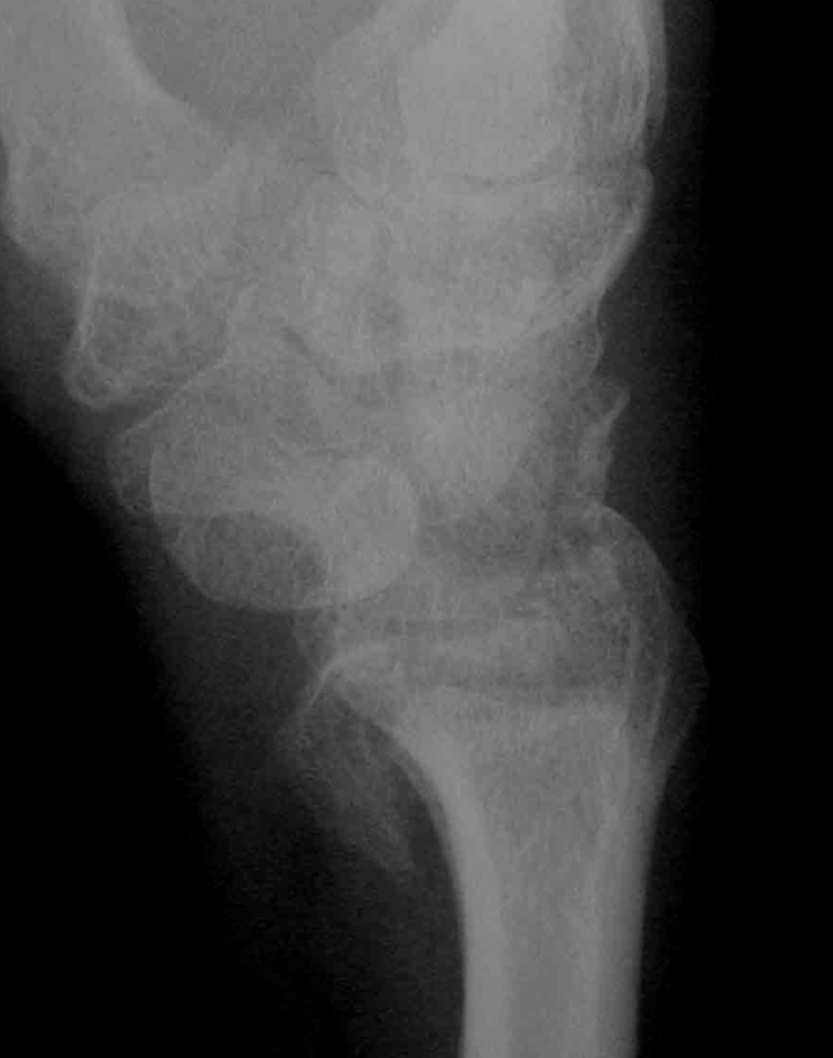 Radial styloid