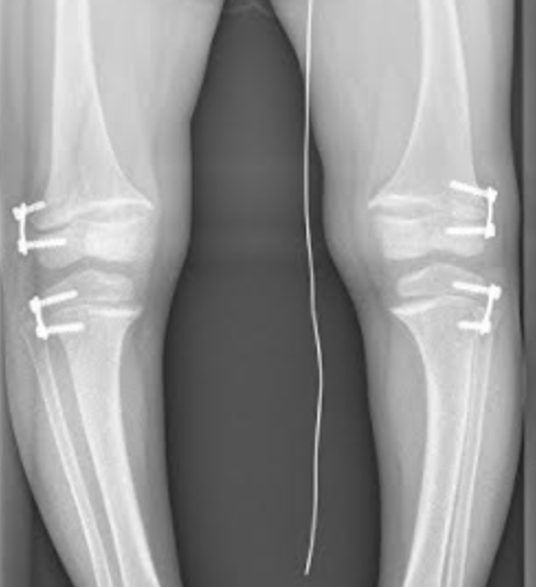 Rickets