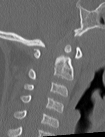 Achondroplasia