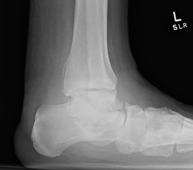 Charcot