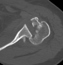 LT fracture